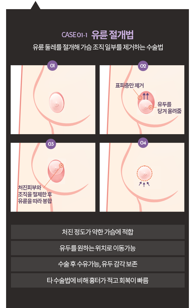 유륜절개법