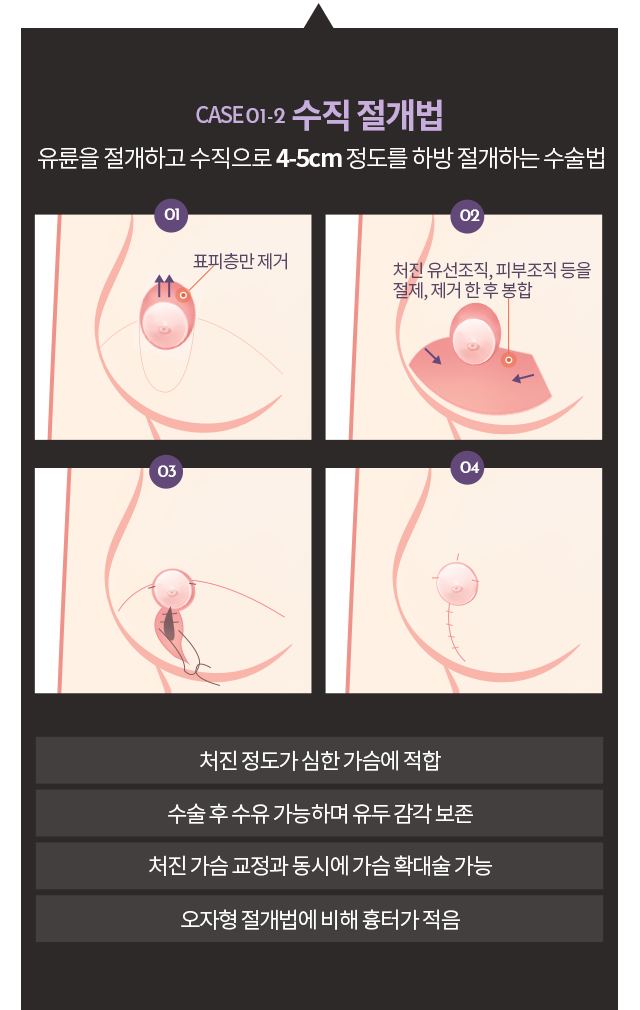 수직절개법