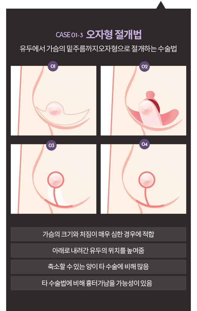 오자형절개법