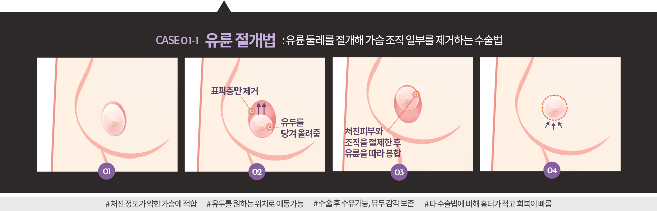 유륜절개법