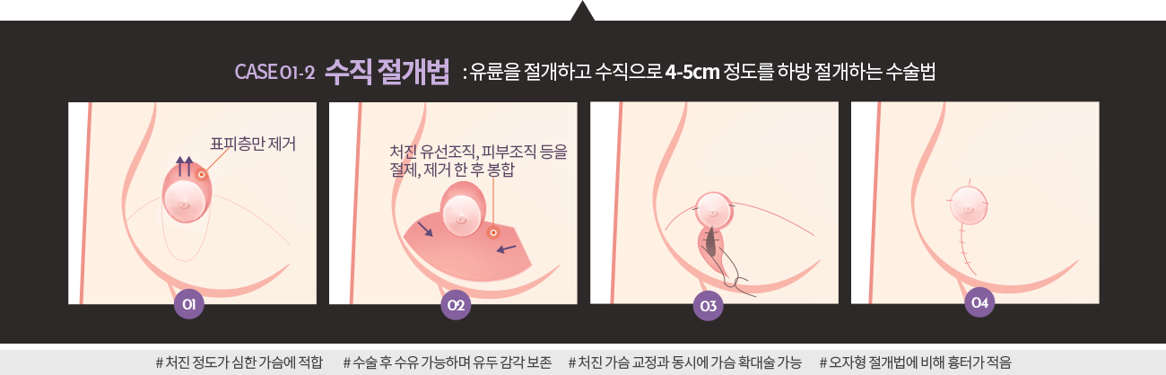 수직절개법