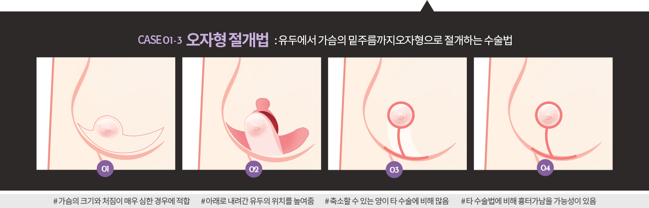 오자형절개법